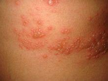 带状疱疹的临床表现有哪些